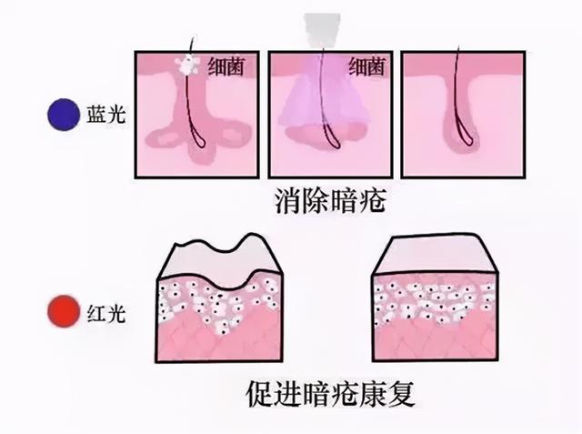 蓝光祛痘多少钱（红蓝光祛痘 照一照痘肌好太多）(3)