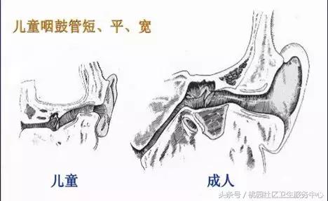 分泌性中耳炎最佳治疗方法（分泌性中耳炎的诊疗技巧）(4)