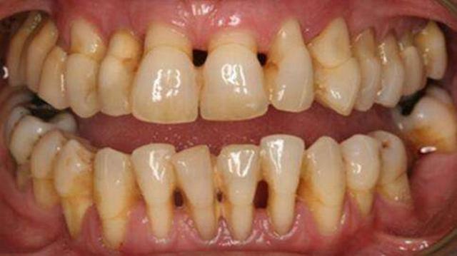 牙缝变大怎么办（牙齿缝隙越来越大怎么办）(2)