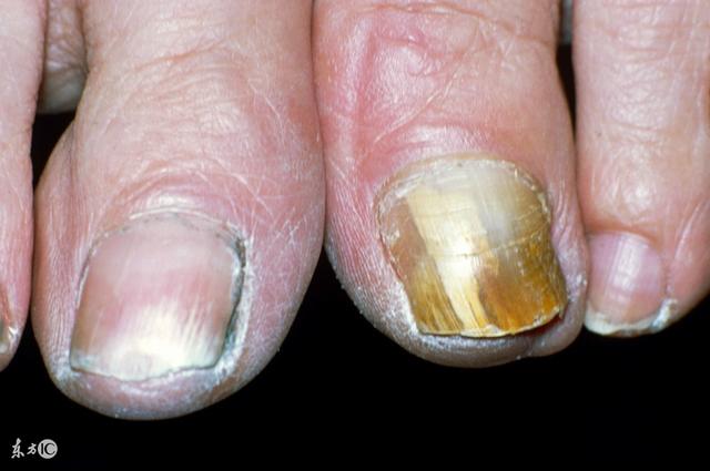 灰指甲是什么症状（如果出现这3个症状）(3)
