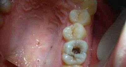 口腔疾病有哪些(5)