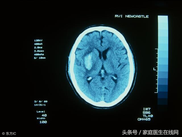 怎样预防脑出血（医生看了这么多年病）(3)