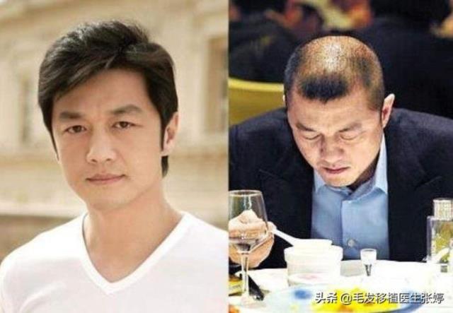 为什么明星不植发（像一些明星、名人很少有做植发的）(4)