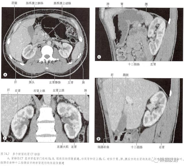 肾脏解剖结构图（解剖丨脾肾上腺泌尿生殖发育）(22)