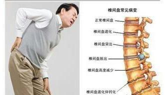 腰椎间盘突出的治疗方法（腰椎间盘突出症的治疗方法全集）(2)
