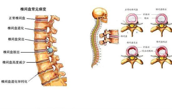 腰椎间盘突出的治疗方法（腰椎间盘突出症的治疗方法全集）(6)