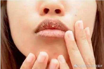 唇干裂是什么原因造成的（嘴唇老是干裂不只是缺水的原因）(1)