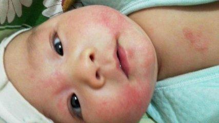 婴儿捂热的疹子图片（宝宝爱长的6类疹子）