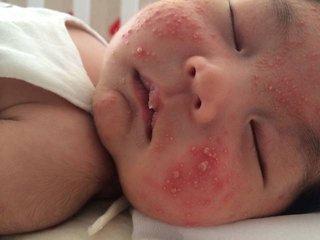 婴儿捂热的疹子图片（宝宝爱长的6类疹子）(3)