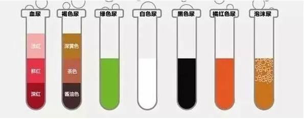 你观察过尿液的颜色吗(4)