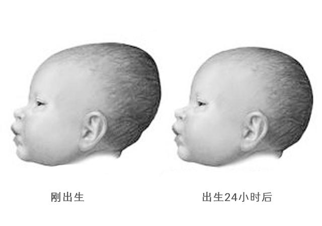 婴儿卤门凹陷图片（宝宝的囟门暗示宝宝的发育状况）(3)