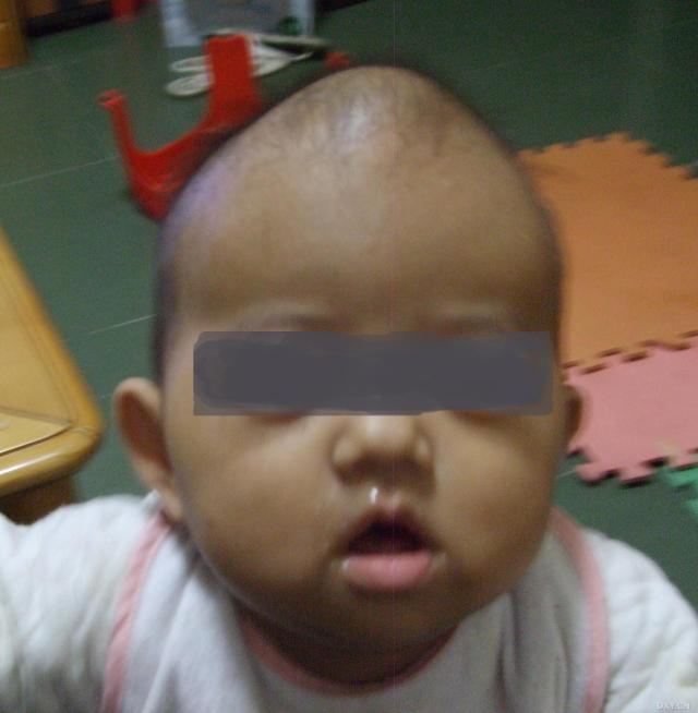 婴儿卤门凹陷图片（宝宝的囟门暗示宝宝的发育状况）(5)