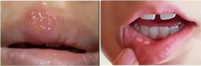 嘴角干燥起皮怎么办（秋冬嘴角干燥、脱皮、发炎）(5)
