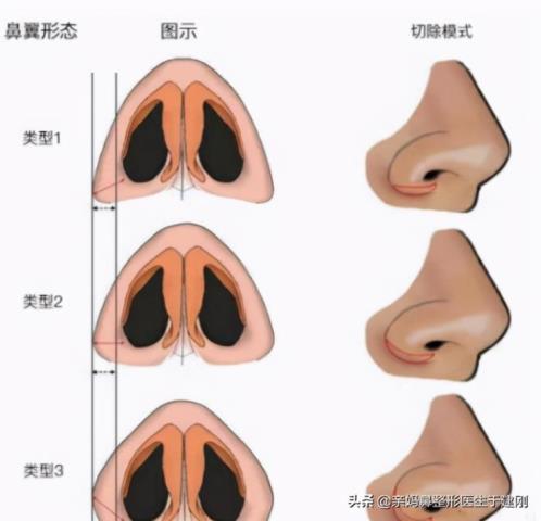 鼻翼怎么缩小（除了割肉还能怎样缩鼻翼）(3)