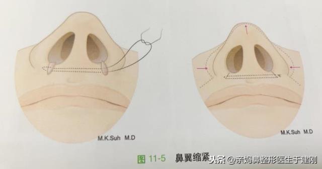 鼻翼怎么缩小（除了割肉还能怎样缩鼻翼）(6)