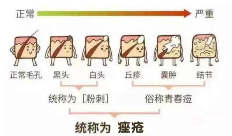 粉刺是什么样的（粉刺、痘痘、痤疮怎么区分）(1)