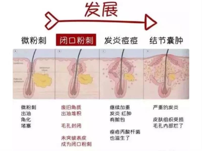 粉刺是什么样的（粉刺、痘痘、痤疮怎么区分）(5)