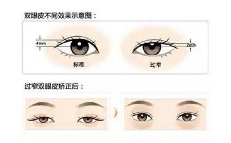 双眼皮修复多久可以做(双眼皮失败多长时间可以修复)(1)