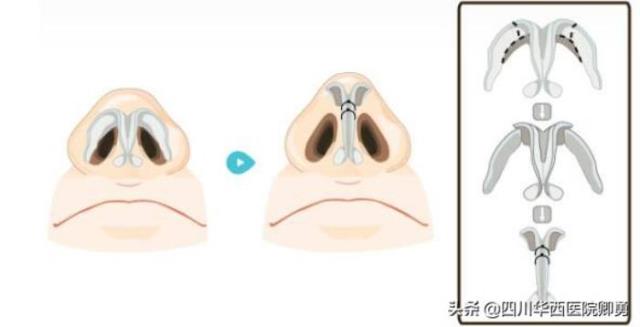 鼻翼缩小的方法（鼻翼缩小术三种常见方法）(1)