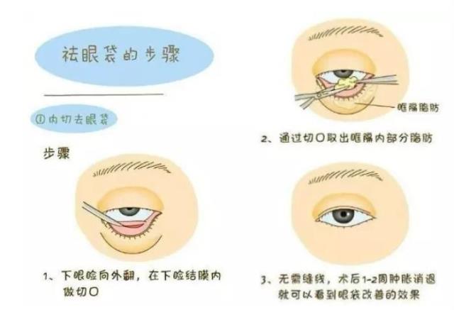 眼袋大是什么原因（造成眼袋大的原因是什么）(5)