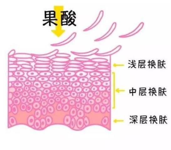 果酸换肤好不好（果酸换肤真的有效吗）(7)