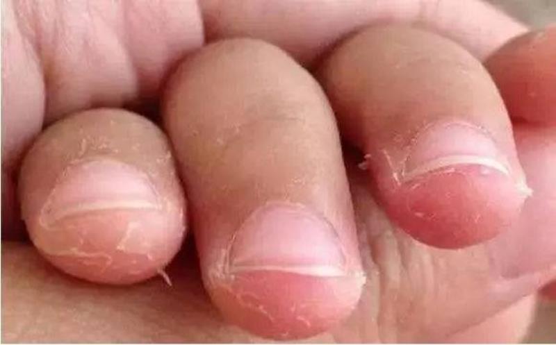 指头脱皮是怎么回事(手指肚一层层脱皮什么原因)(1)