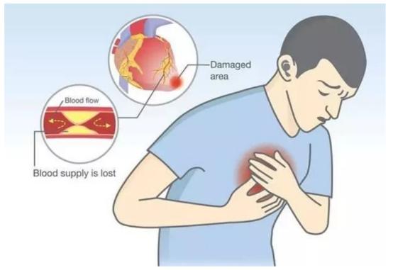 心肌梗塞前，身体会发出7个“求救信号”，记住了或可挽救生命