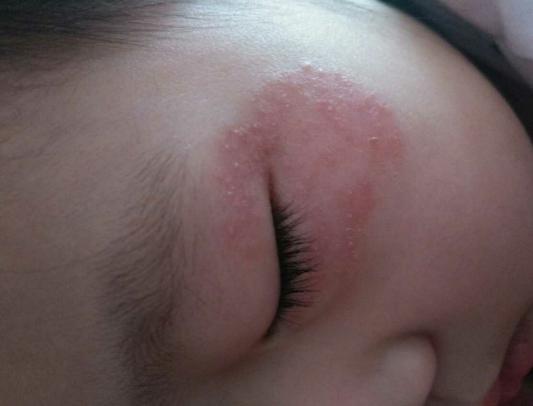 宝宝眼睑发红长小疹子（四岁宝宝的眼角出现红疹）