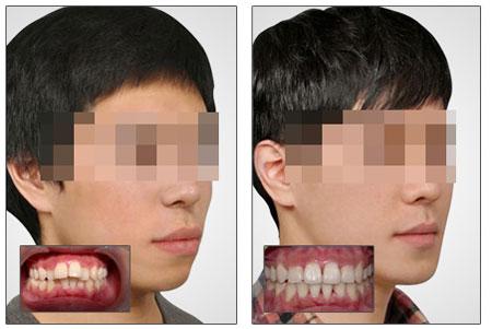 龅牙矫正可以改善嘴型吗（龅牙矫正究竟能让脸型变好看吗）(1)
