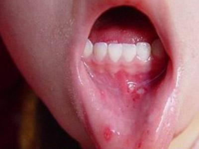 口腔溃疡抹香油还是牙膏（口腔溃疡太难受）(2)