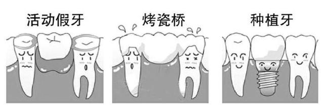 镶牙的形式有几种（短科普镶牙的种类有哪些）(1)