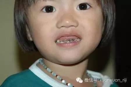 如何预防孩子得龋齿（触目惊心的儿童龋齿）(2)