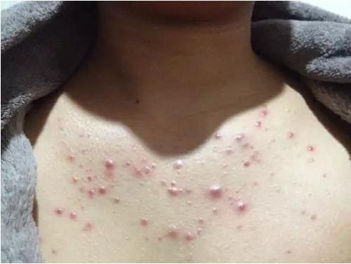 前胸和后背长痘痘是什么原因（很多女生会前胸后背长痘痘的原因）(1)