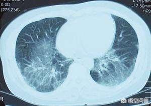 间质性肺炎和肺癌症状区分（间质性肺炎是一种什么样的疾病）(3)