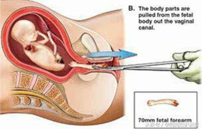 有过怀孕的女人可以做流产吗（女人流产时宝宝是如何）(3)