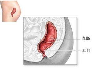直肠脱垂易导致什么并发症（直肠脱垂对人体产生哪些不良影响）(1)