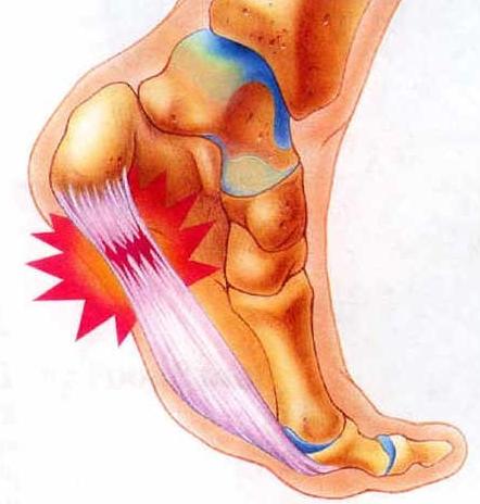 足底筋膜炎会不会引起脚后跟疼（一踩地就脚痛怎么办）