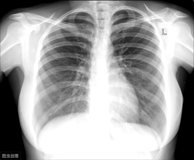 体检检查到肺部有结节（体检发现肺部结节怎么办）(2)