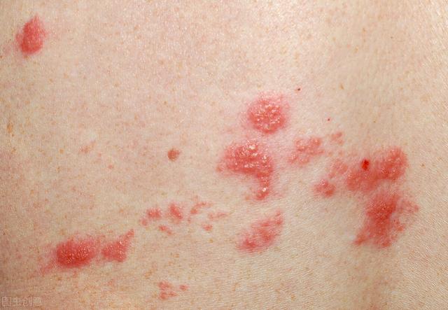 皮肤起水泡一般是什么病（皮肤上突然出现了水疱）(3)