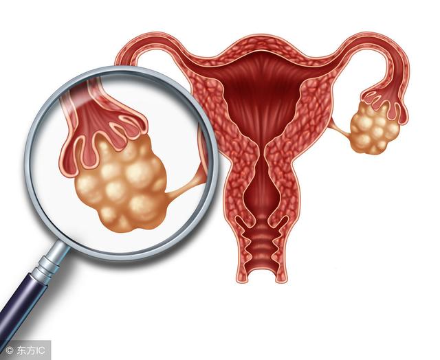 多囊卵巢综合征不容易怀孕（什么是多囊卵巢综合征）