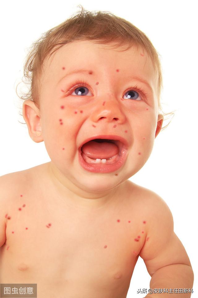 儿童皮肤病如何护理（最全的儿童皮肤病防治及居家护理方法）(2)