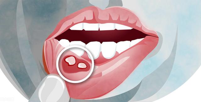 经常口腔溃疡是缺维生素吗 口腔溃疡是缺乏维生素吗(1)