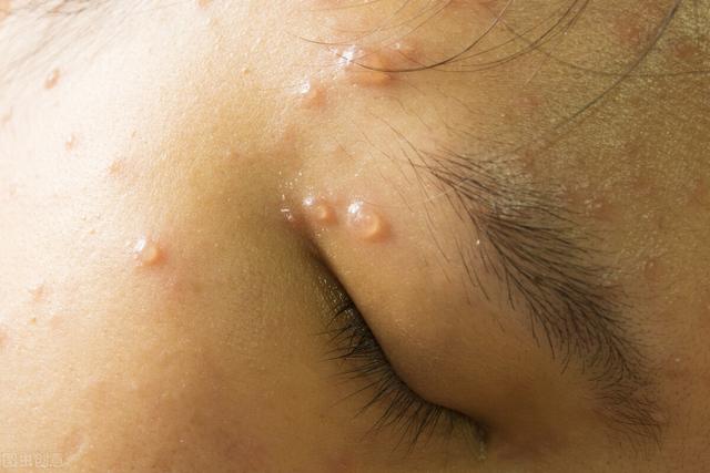 皮肤起水泡一般是什么病（皮肤上突然出现了水疱）