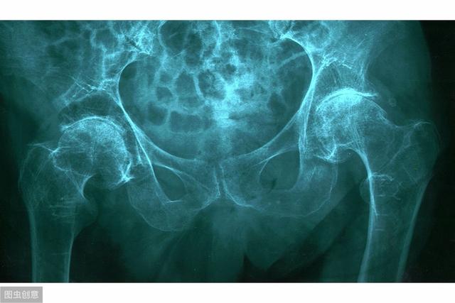 什么是骨质疏松有何表现和预防（什么是骨质疏松症）(4)