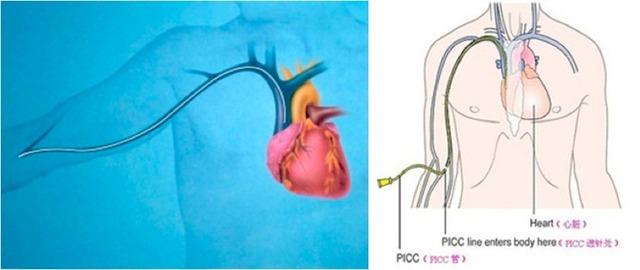picc置管后发生血栓后的护理（护理角度谈PICC相关性静脉血栓）(4)