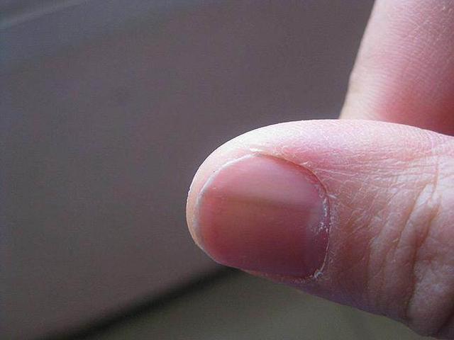 指甲出现竖纹是身体出了什么问题（指甲上出现竖纹）(2)