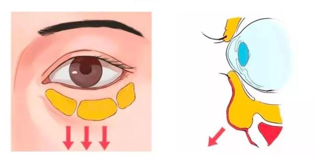 下眼袋大最简单的去眼袋的方法（眼袋有多重你就有多老）(6)