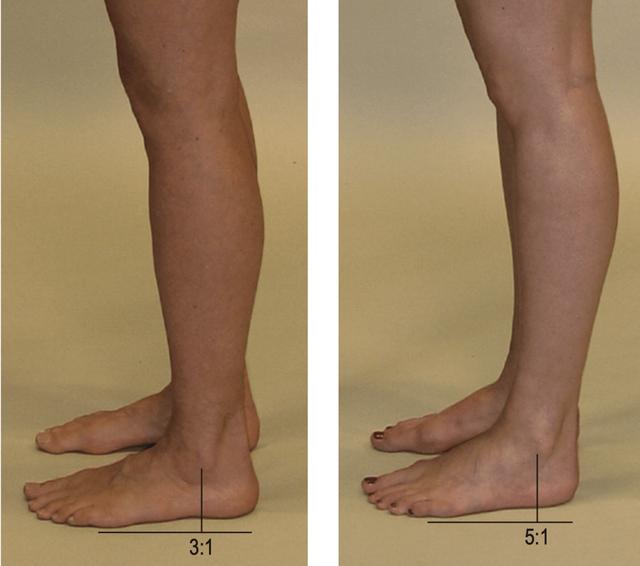 扁平足导致小腿粗壮怎么瘦下来（扁平足导致短粗腿）(5)