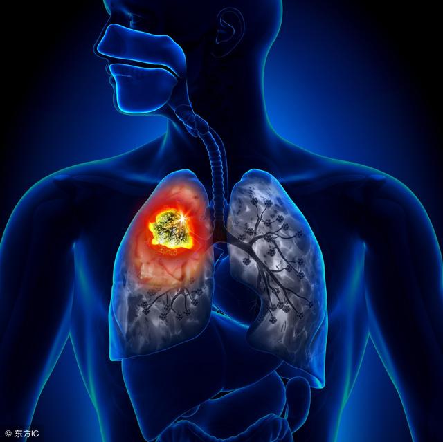 肺癌的中晚期症状有哪些（肺癌早期不易被发现）