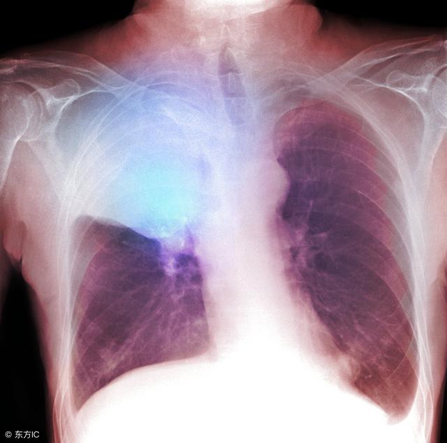 肺癌晚期临死之前什么症状（肺癌晚期死前症状是什么呢）(1)